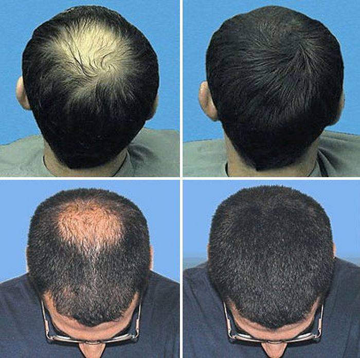 Как ускорить рост волос мужчине на голове