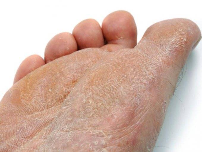Почему шелушится кожа на ногах ниже колен у женщин
