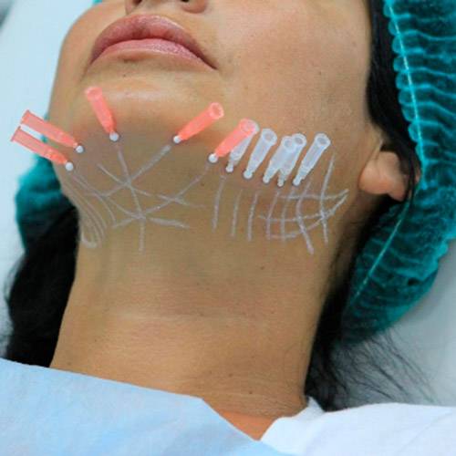 Мезонити для подтяжки лица и их виды