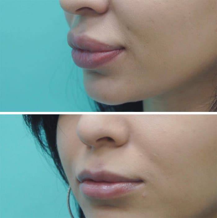 Как приподнять уголки губ филлером фото до и после