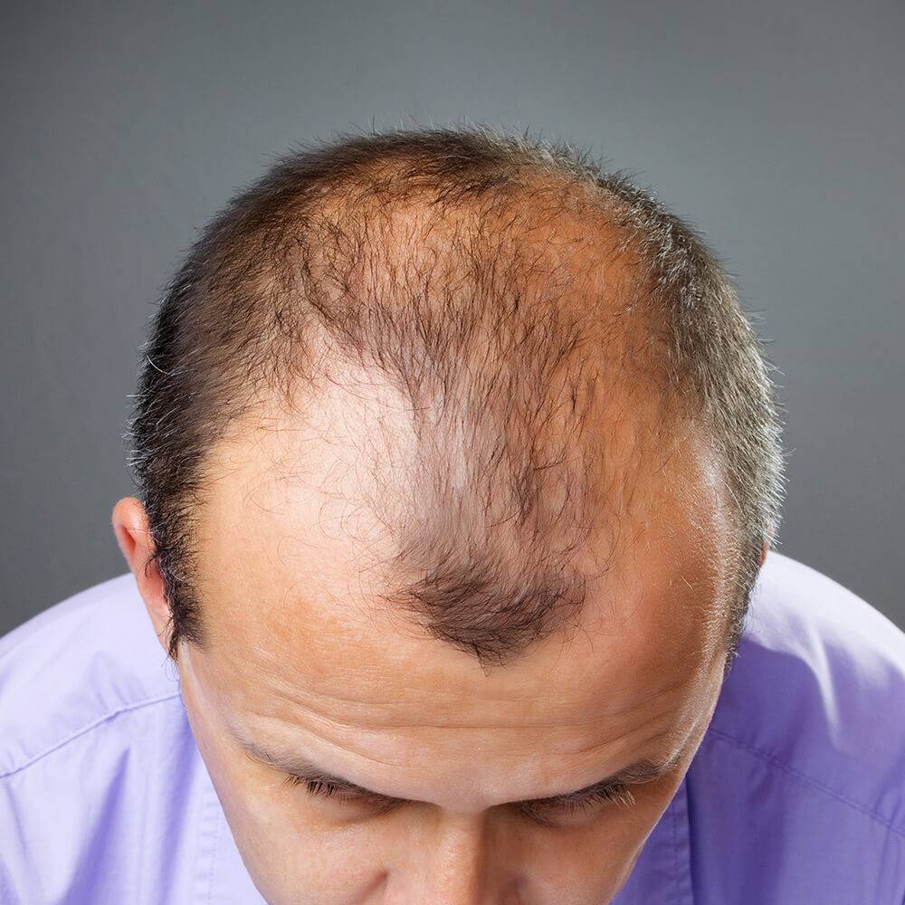 Лысеющий лоб. Очаговая алопеция (alopecia Areata). Редкие волосы. Прически с облысением.