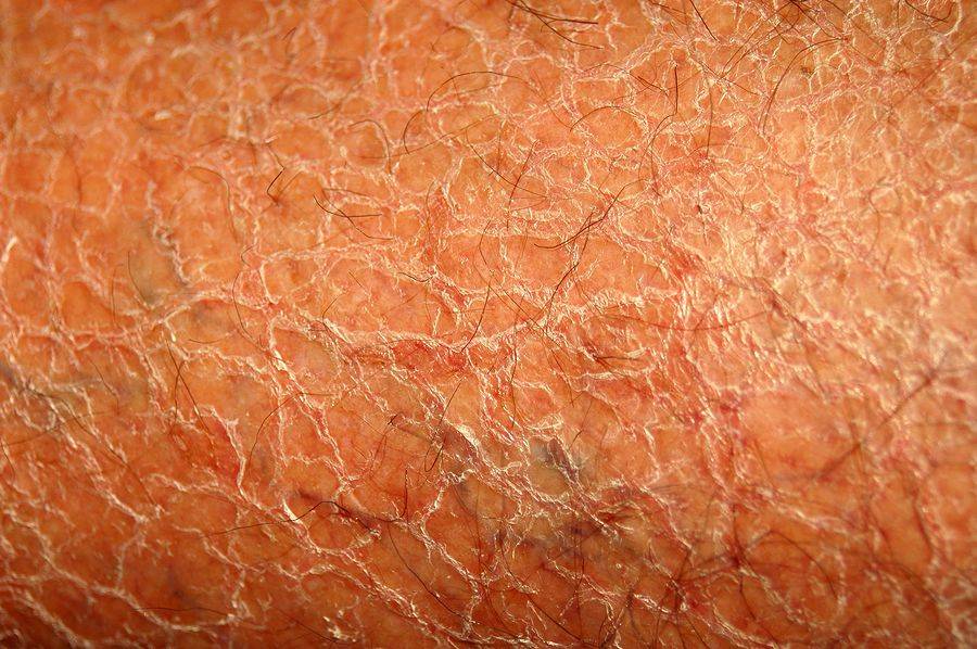 Шелушится кожа на ногах: причины, профилактика