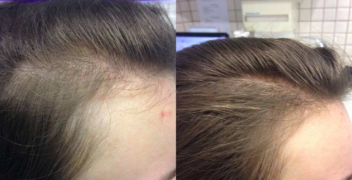 После ковида выпадают волосы что делать. Мезотерапия для волос. Поредение волос у женщин. Мезотерапия волос картинки.