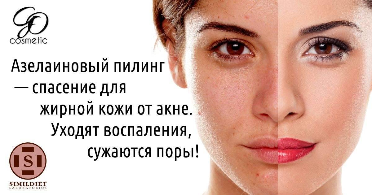 Азелаиновый пилинг спасает от угрей, черных точек и жирных пор