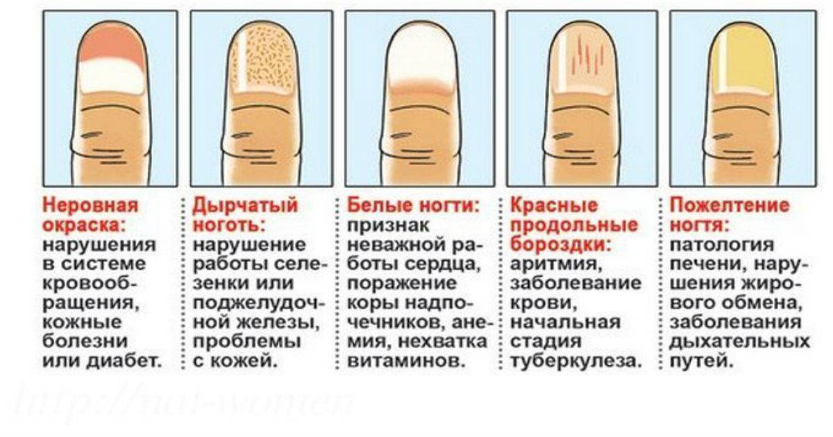 Что означают белые пятна на ногтях рук
