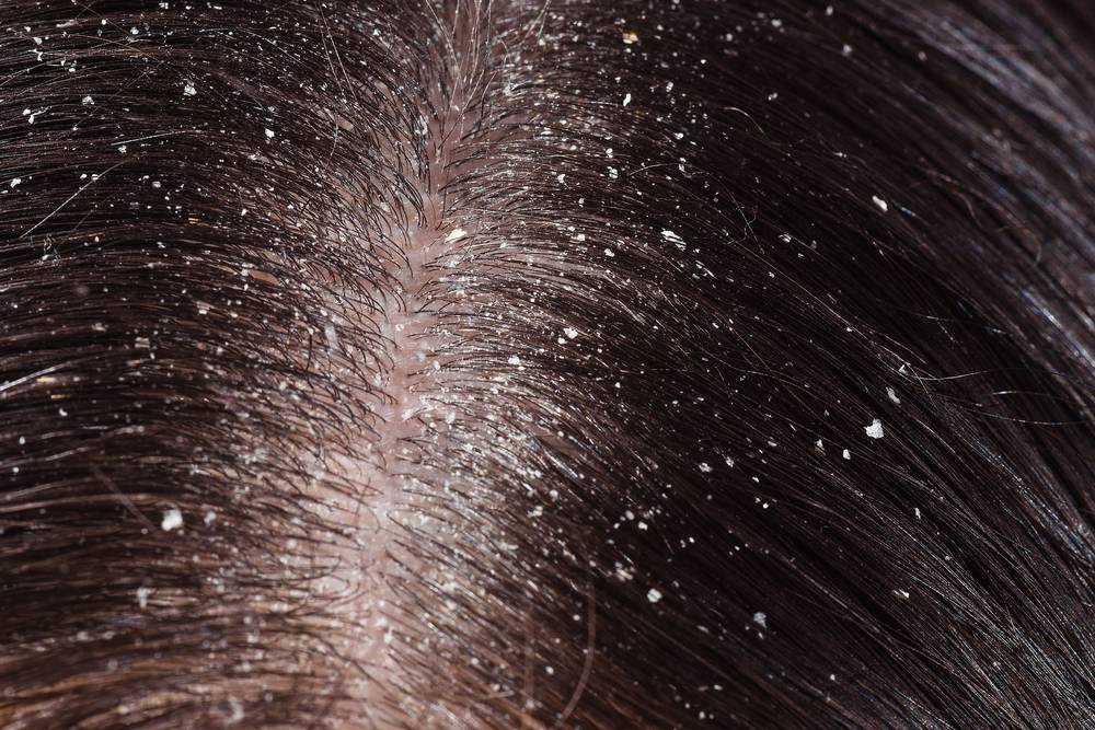 Народные средства от перхоти и выпадения волос: рецепты, действие компонентов, курс лечения и результаты