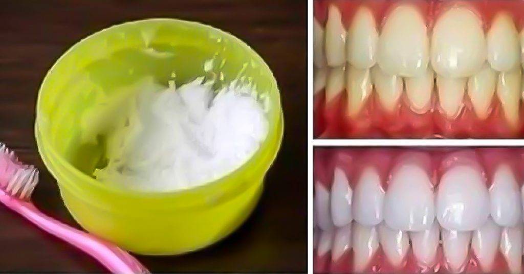 отбеливание зубов димексидом