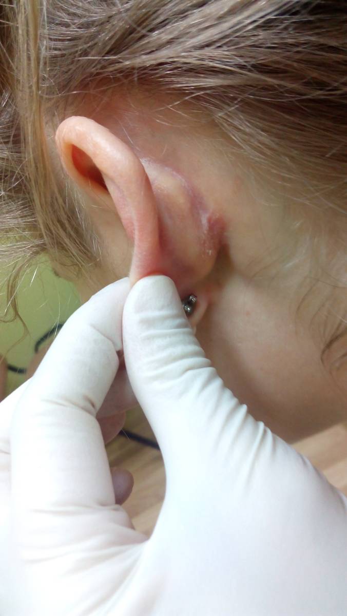 За ушами чешется и мокнет — чем лечить? - сам себе доктор