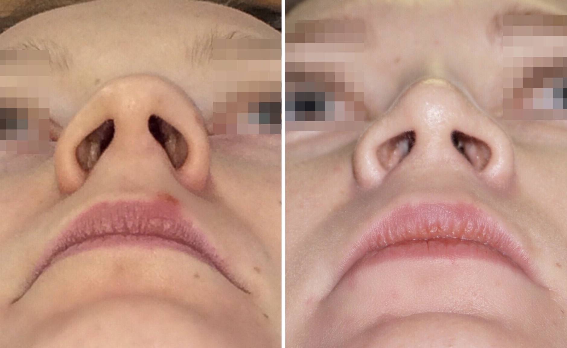 Операция по исправлению носовой перегородки