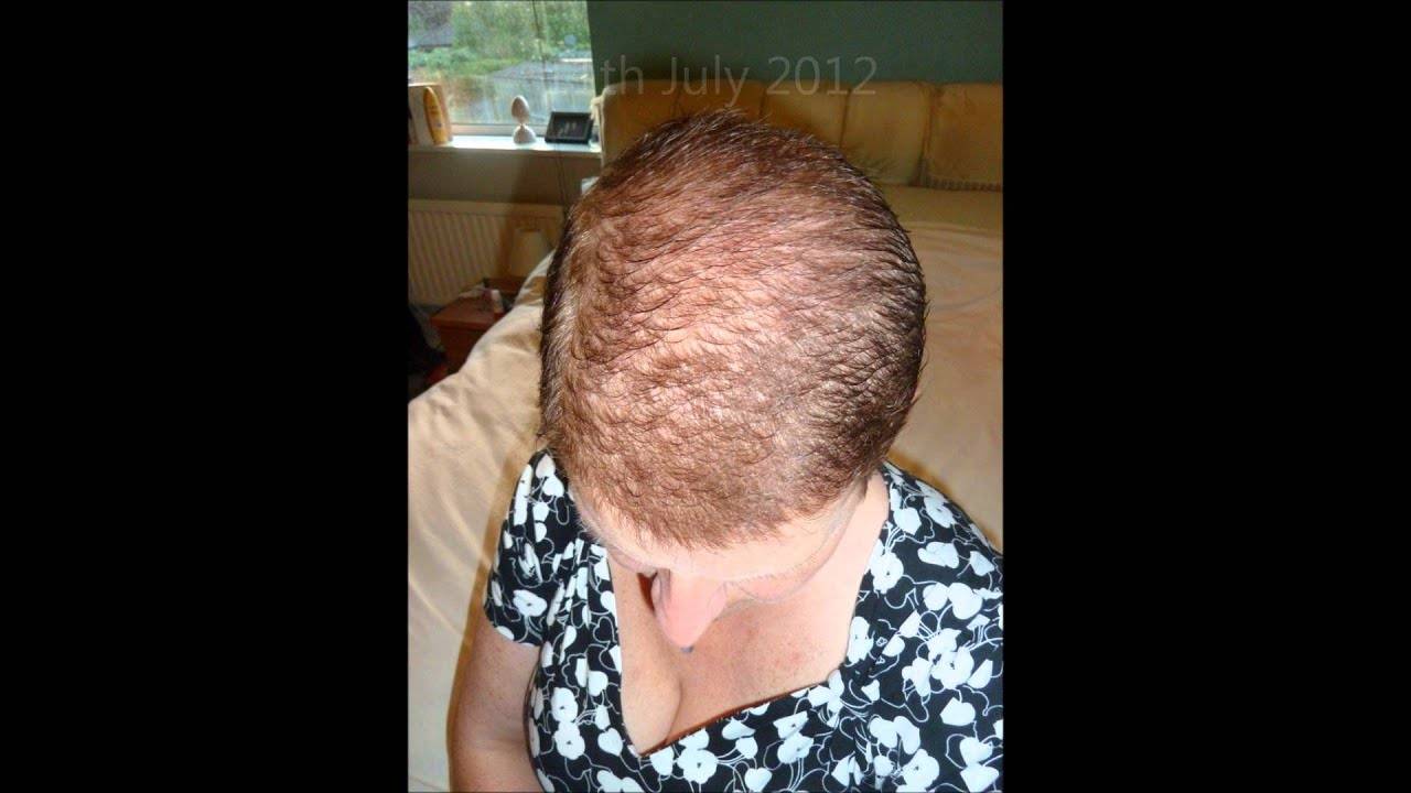 После коронавируса выпадают волосы. Волосы после химиотерапии. Алопеция после химиотерапии. Выпадение волос после химиотерапии.
