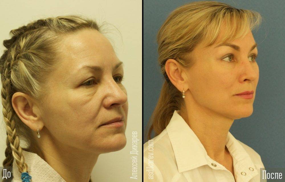 Эндоскопическая подтяжка лица — показания, преимущества, отзывы