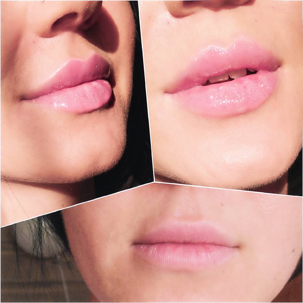 Какие губы после гиалуроновой кислоты