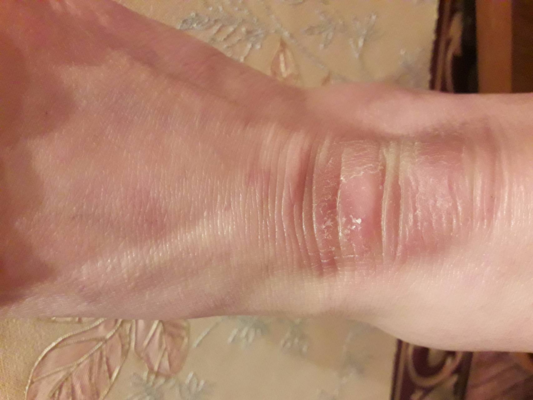 Что делать, если сухая кожа на ногах