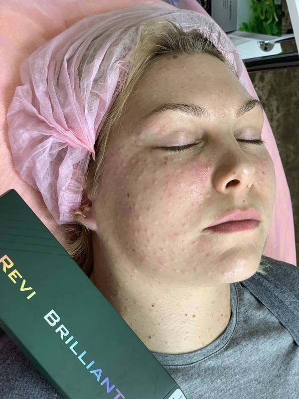 Препарат реви — метод коррекции возрастных изменений