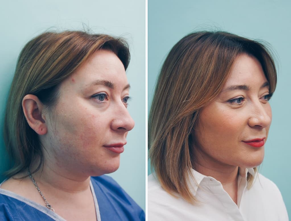 Как делают подтяжку лица хирургическим путем фото до и после