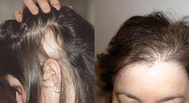 Выпадение волос у женщин: причины, лечение, средства
