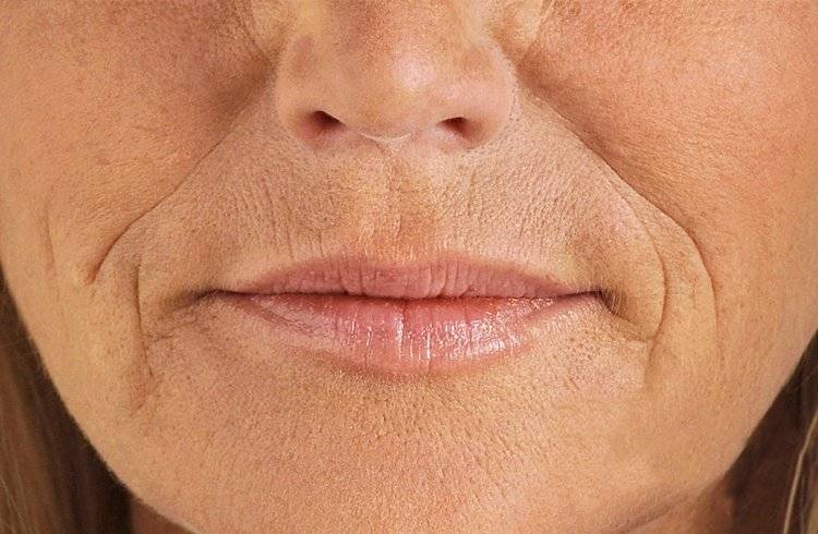 Как убрать носогубные складки в домашних условиях и в салоне красоты: лучшие методы