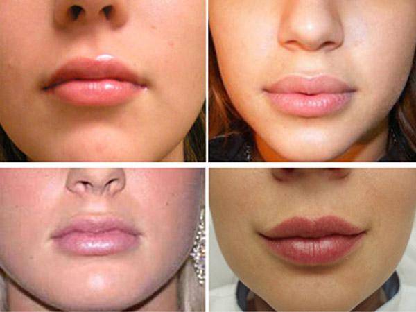 Отличный способ сделать губы красивыми — хейлопластика. описание vy-метода и других популярных техник