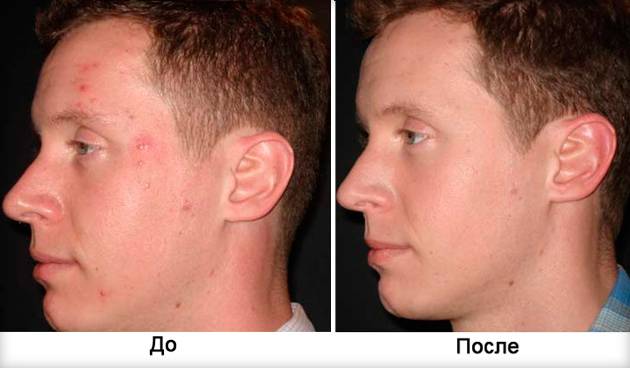 Дарсонваль для лица: польза, применение от прыщей и морщин, какой аппарат выбрать, фото и отзывы