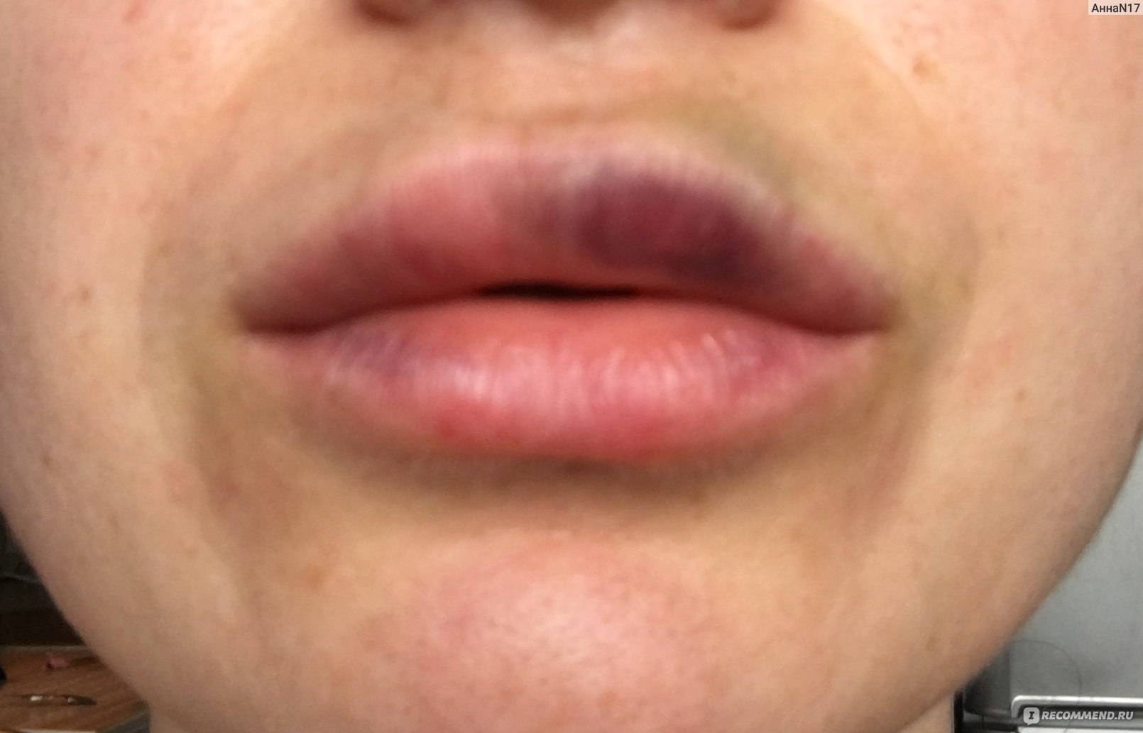 Увеличение губ гиалуроновой кислотой и синяки: как избавиться от гематом