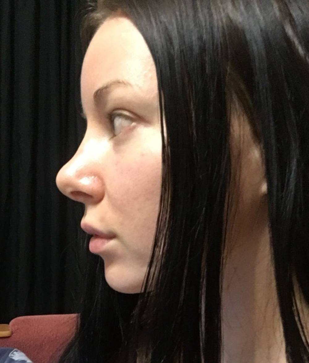 Ринопластика широкого носа