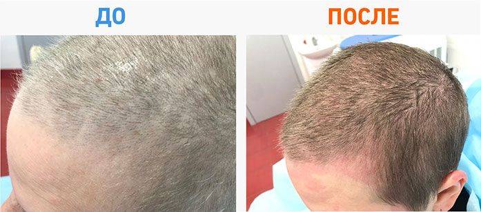 Сколько отрастают волосы у мужчин. Рост волос после химиотерапии. После химиотерапии волосы растут. Выпадение волос после химиотерапии.