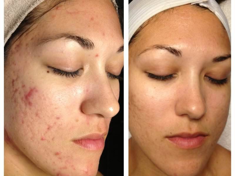 Мануальная чистка лица – эффективное средство для красоты кожи