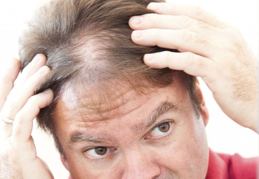 Почему происходит выпадение волос на голове у мужчин