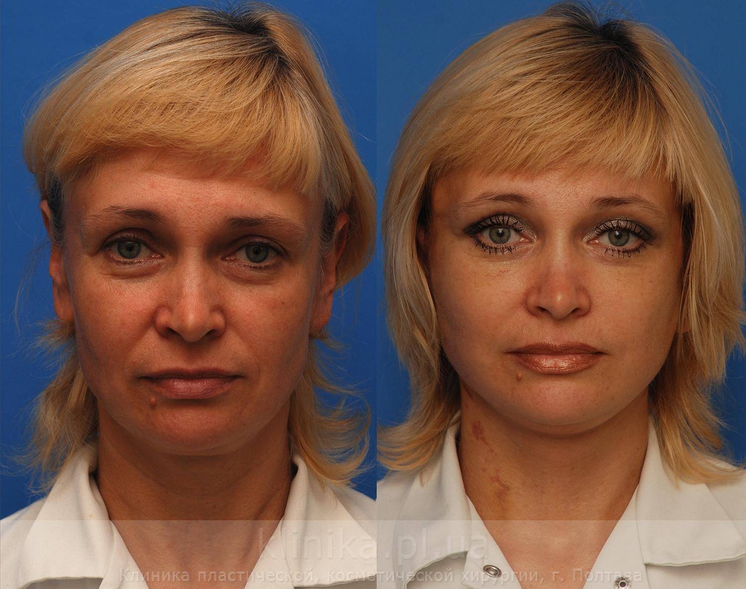 Эндоскопическая подтяжка верхней трети лица фото до и после