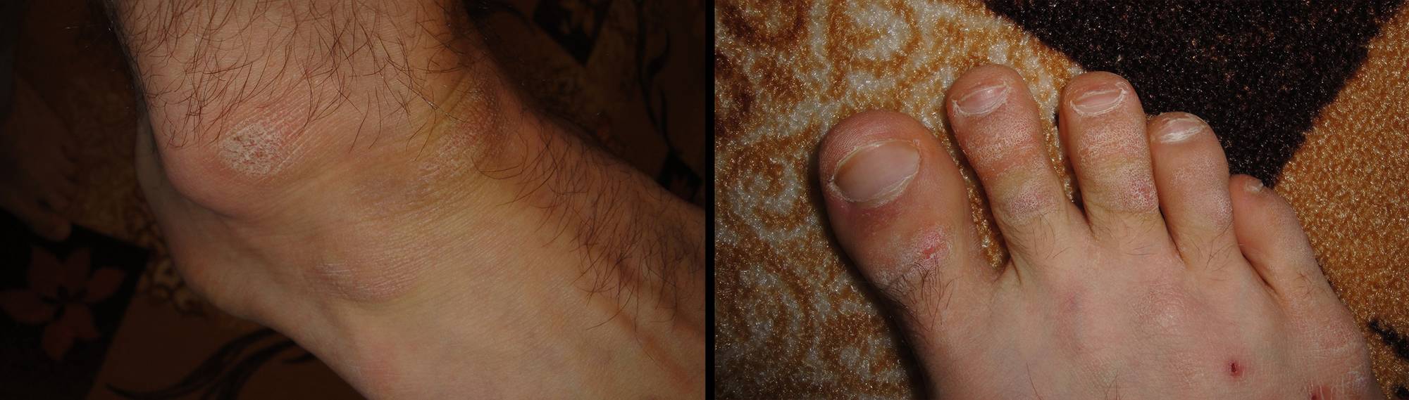 Шелушится кожа на большом пальце ноги, причины и лечение
