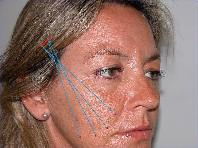 Нитевой лифтинг- возвращаем молодость безоперационной подтяжкой лица
