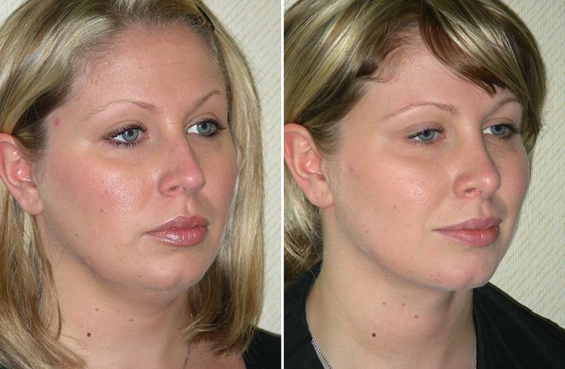 Липолитики для лица: отзывы, фото до и после применения