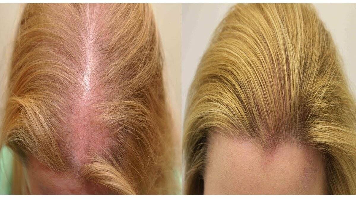 Почему волосы растут медленно и как ускорить процесс их роста?