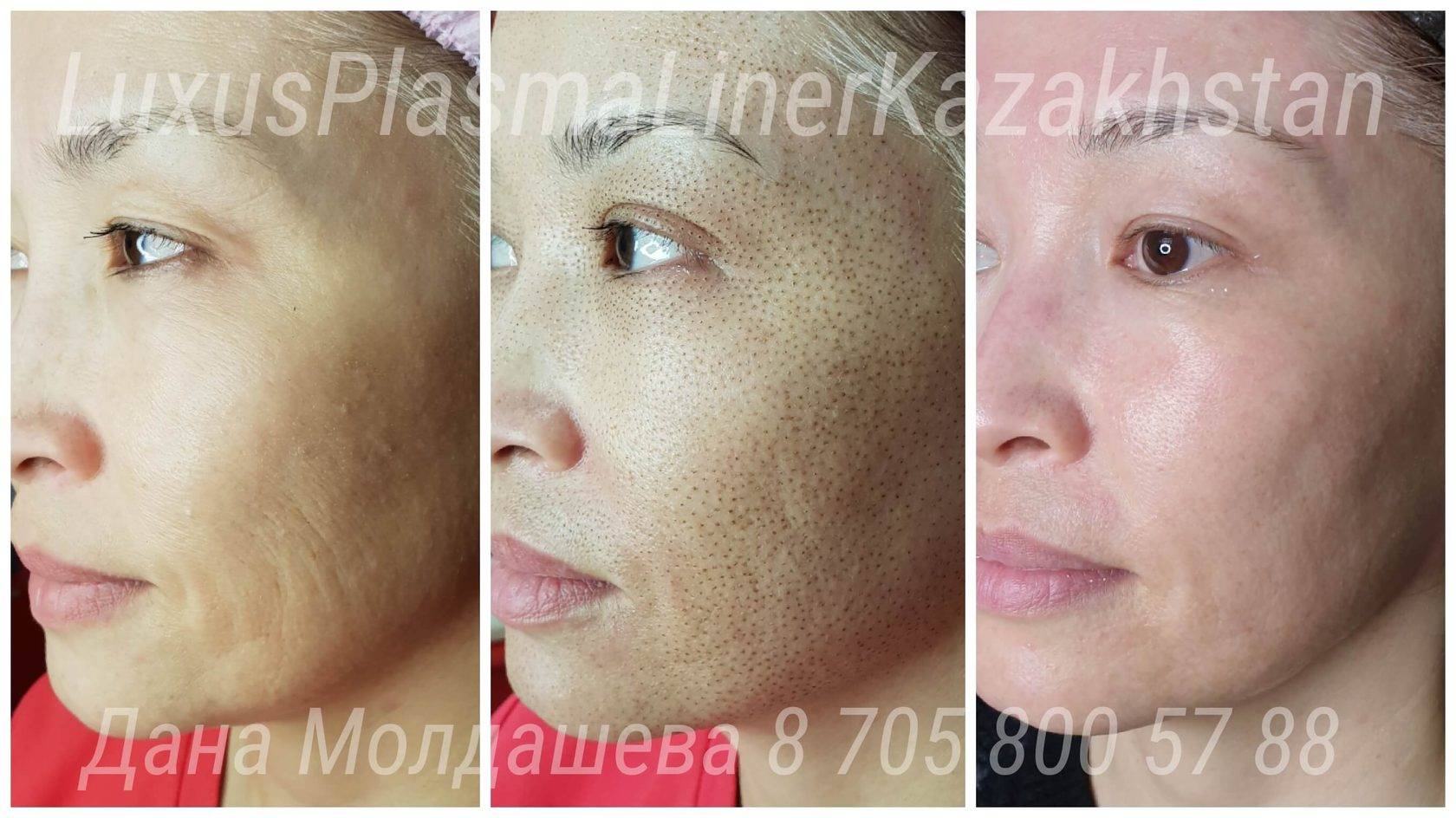 Neogen — омоложение плазмой! новейшая технология в эстетической медицине