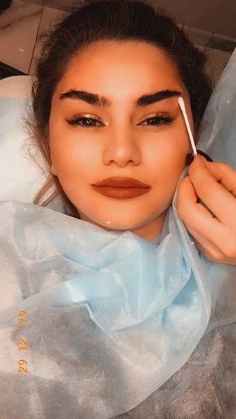 Глаза как у беллы хадид: кантопластика (сделает открытый взгляд или хитрый прищур)