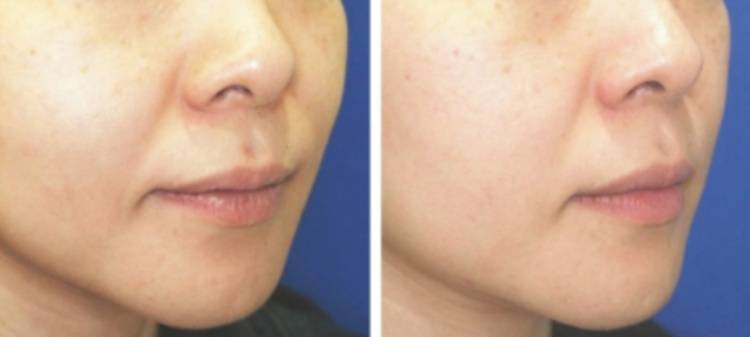 Мезотерапия тела для похудения – отзывы, инъекции липолитиков в живот