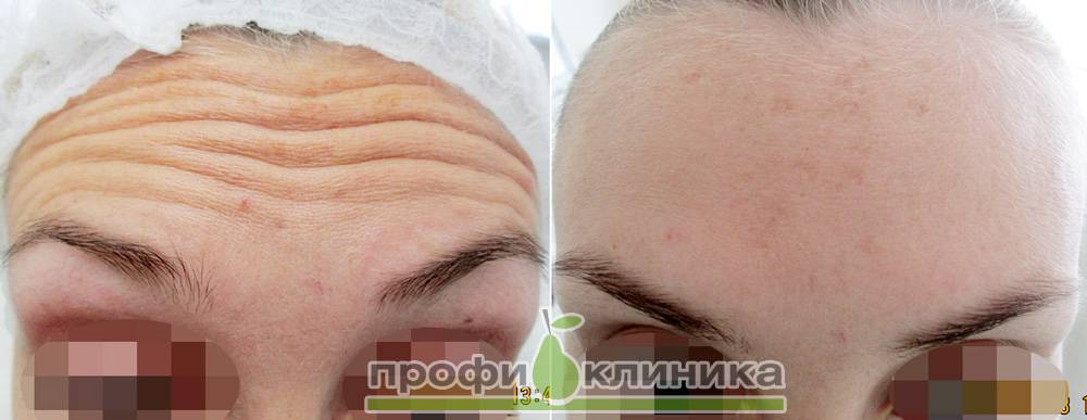 Аллергия на ботокс • аллергия и аллергические реакции