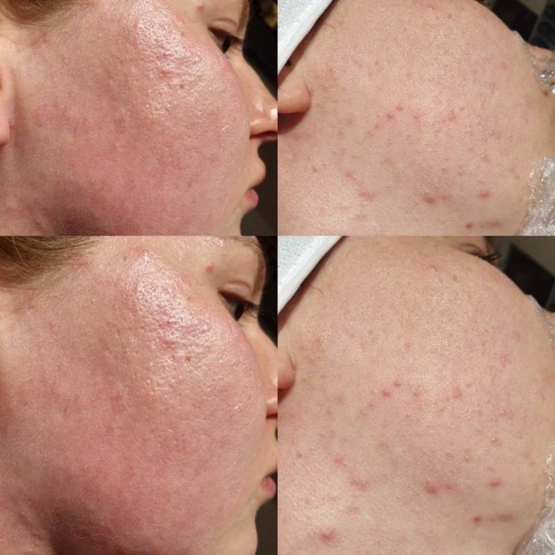 Коралловый пилинг rose de mer для лица: что это такое, отзывы, фото до и после, протокол процедуры (2019)