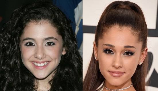 Ариана гранде до и после пластики | всё о пластической хирургии