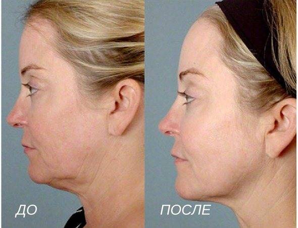 Smas лифтинг - виды, как делается и эффективность + отзывы и фото до/после