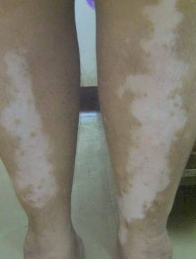 Пигментация кожи причины и лечение у женщин у мужчин у детей