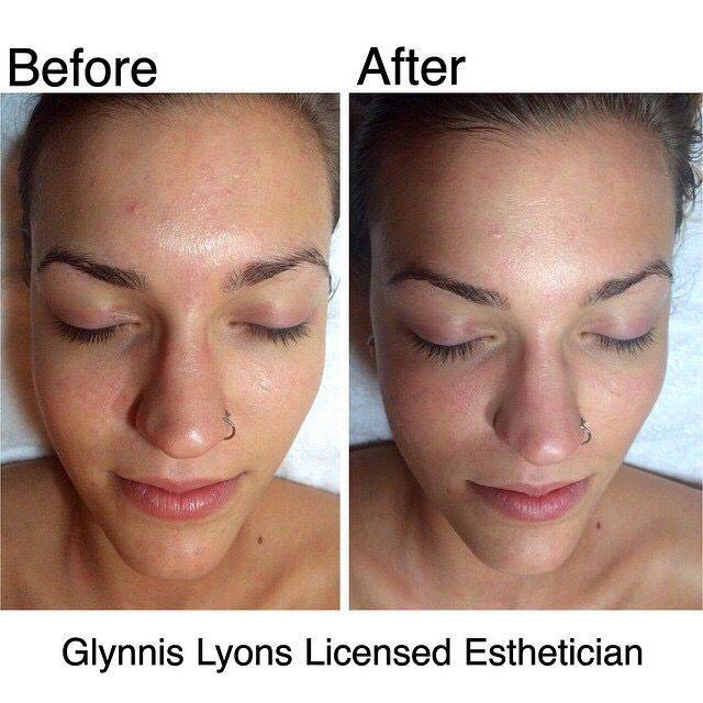 Promoitalia pq age пилинг – инновационный метод омоложения лица