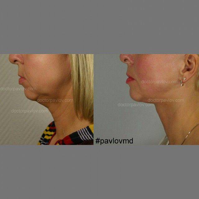 Височный лифтинг