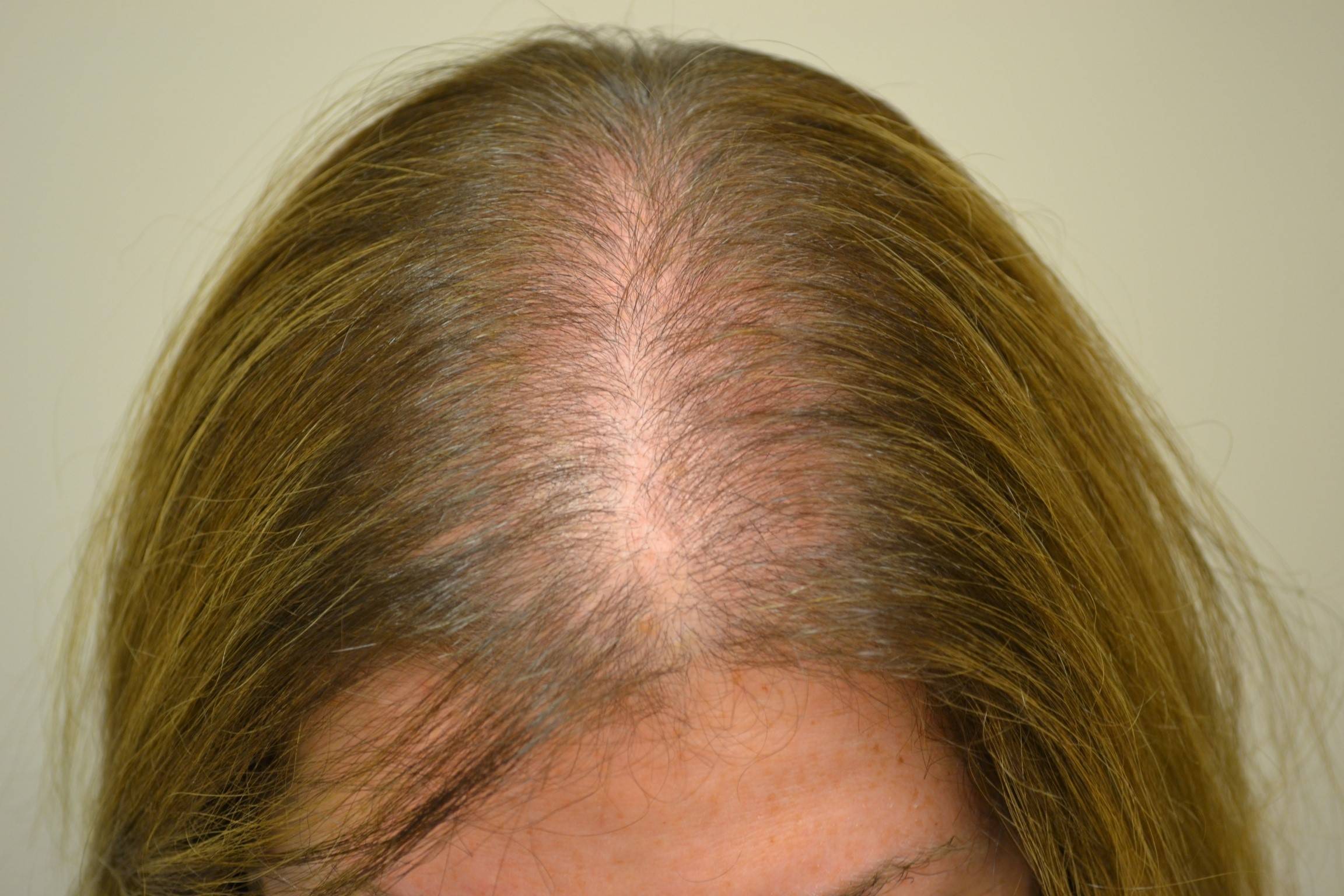Выпадают волосы у женщины сильно на голове. Андрогенная алопеция алопеция. Диффузная телогеновая алопеция. Андрогенноя аполоцея у женщин.