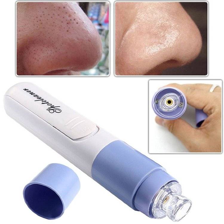 Вакуумный очиститель пор для лица: как пользоваться, эффект, топ лучших, реальные отзывы