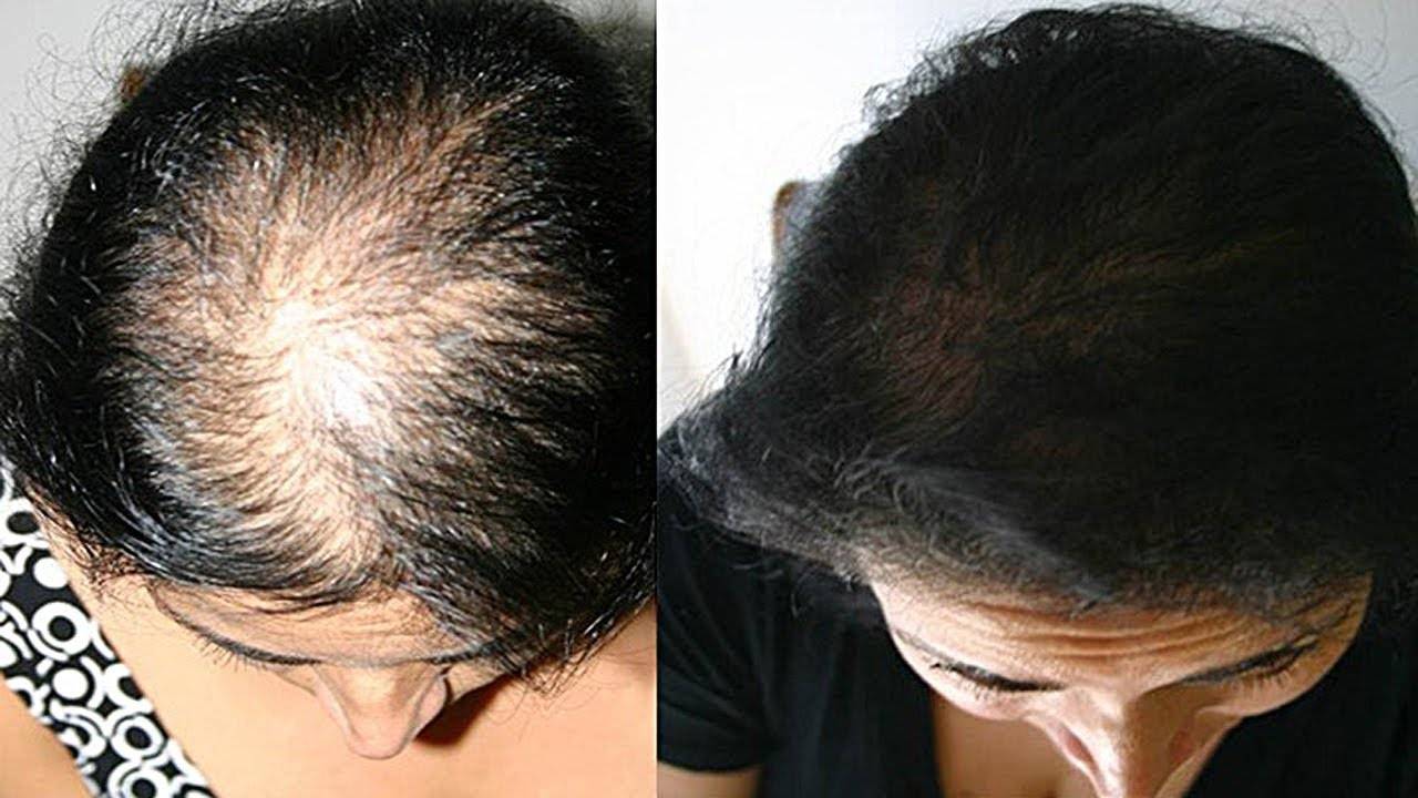 Выпадение волос у женщин: причины, методы лечения