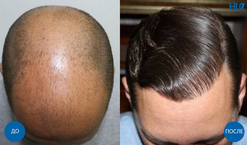 Как ускорить рост волос мужчине на голове. Трансплантация волос на голове. Волосы после пересадки волос. Пересадка волос с затылка.