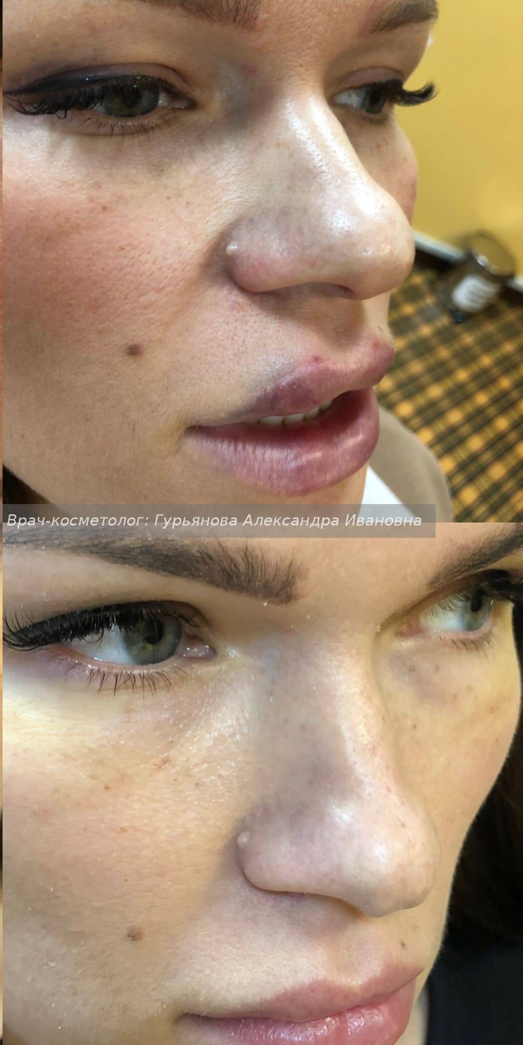 Безоперационная ринопластика носа: методы и особенности, осложнения, реабилитация