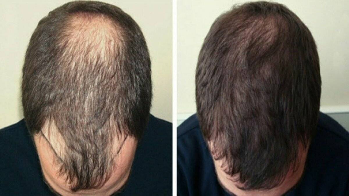 Маски против выпадение волос бровей