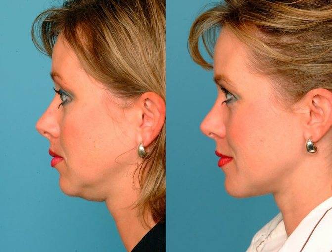 Второй подбородок у мужчин причины появления, от чего растет, как избавиться